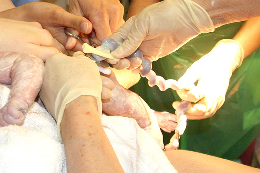 Conservazione e trasporto del sangue da cordone ombelicale