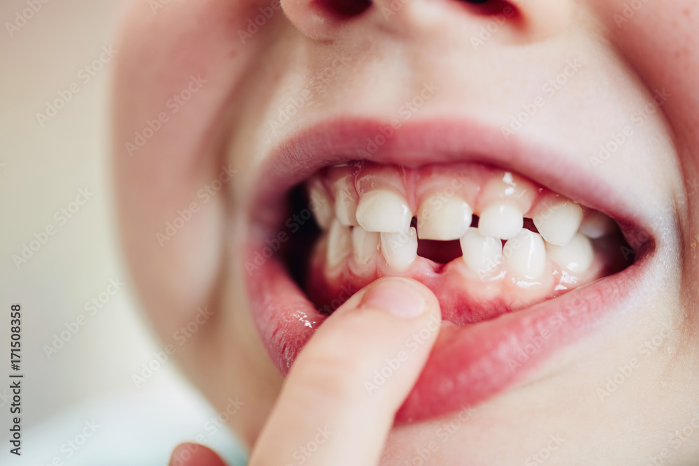Bambino sorridente - Paziente con esigenze speciali